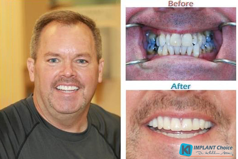 K1Implant Choice Allon4 Full Mouth Dental Implants in 1Day