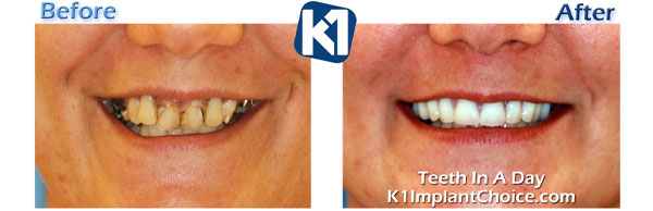All on 4 Before After NFK 1 Implant Choice 5 web