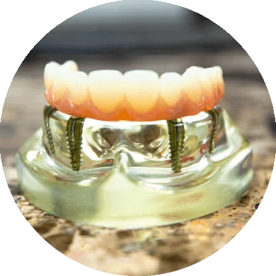 full mouth implant model on table