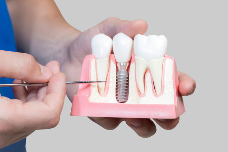 An image of a dental implant model.