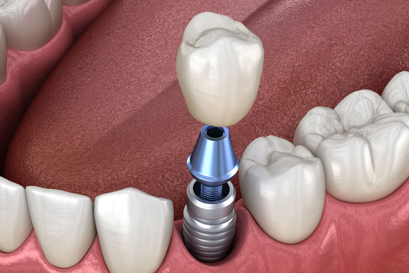a dental implant model that shows how dental implants reliably replace missing teeth with a dental implant post, an abutment, and a tooth crown.