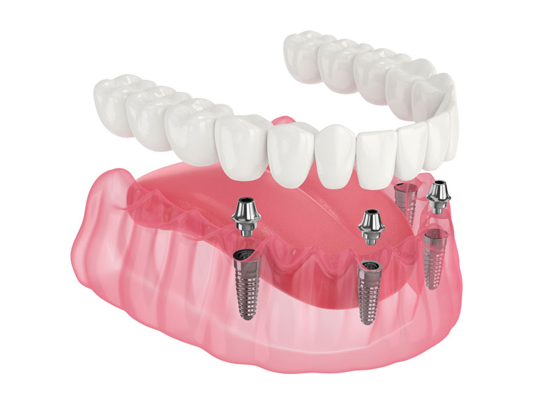 3d model of a All-On-4 Dental Implants