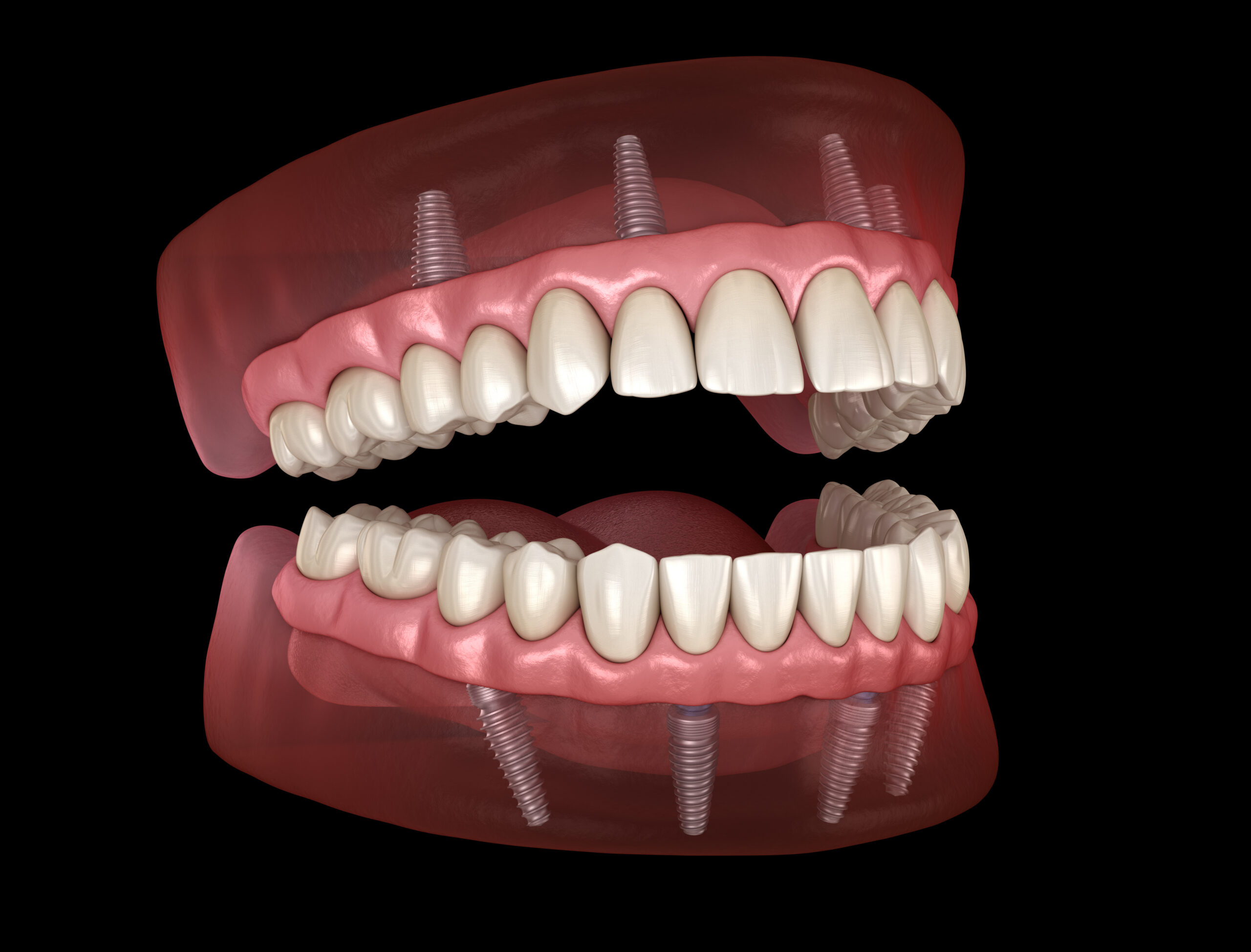 3D model of an all-on-four dental implants in Toledo, OH.